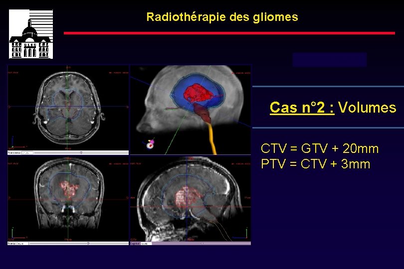 Radiothérapie des gliomes Dose totale : 54 Gy Cas n° 2 : Volumes CTV