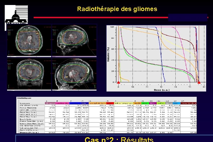 Radiothérapie des gliomes Dose totale : 54 Gy 