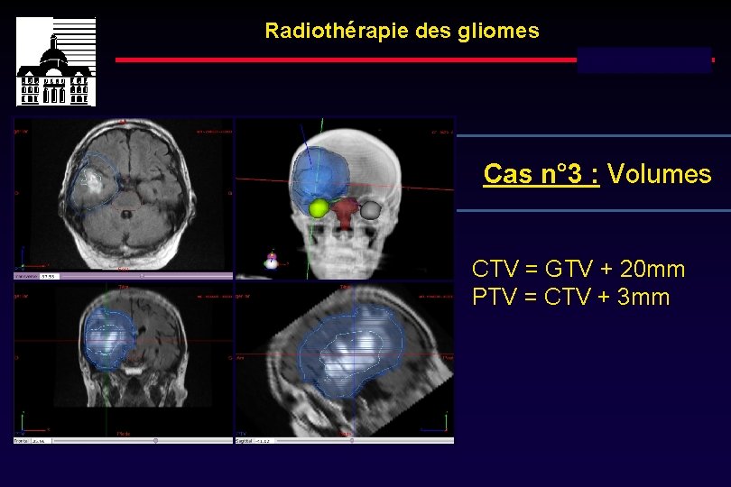 Radiothérapie des gliomes Dose totale : 60 Gy Cas n° 3 : Volumes CTV