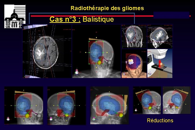 Radiothérapie des gliomes Cas n° 3 : Balistique Dose totale : 60 Gy Réductions