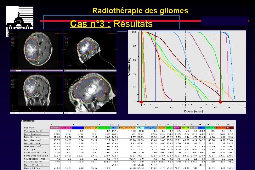 Radiothérapie des gliomes Cas n° 3 : Résultats Dose totale : 60 Gy 