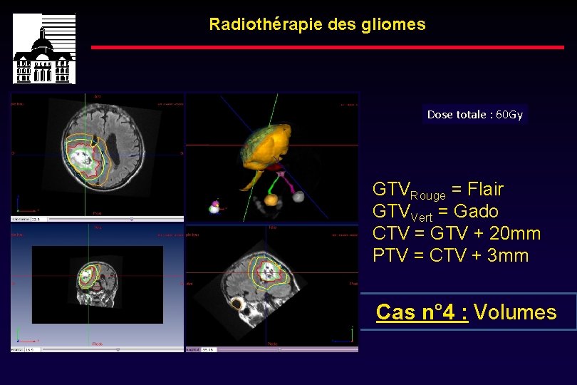 Radiothérapie des gliomes Dose totale : 60 Gy GTVRouge = Flair GTVVert = Gado