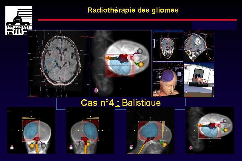 Radiothérapie des gliomes Dose totale : 60 Gy Cas n° 4 : Balistique 