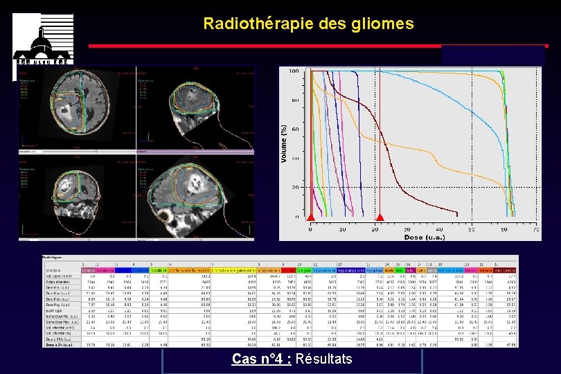 Radiothérapie des gliomes Dose totale : 60 Gy Cas n° 4 : Résultats 