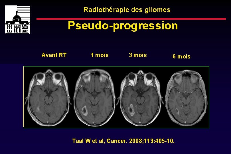 Radiothérapie des gliomes Pseudo-progression Avant RT 1 mois 3 mois 6 mois Taal W