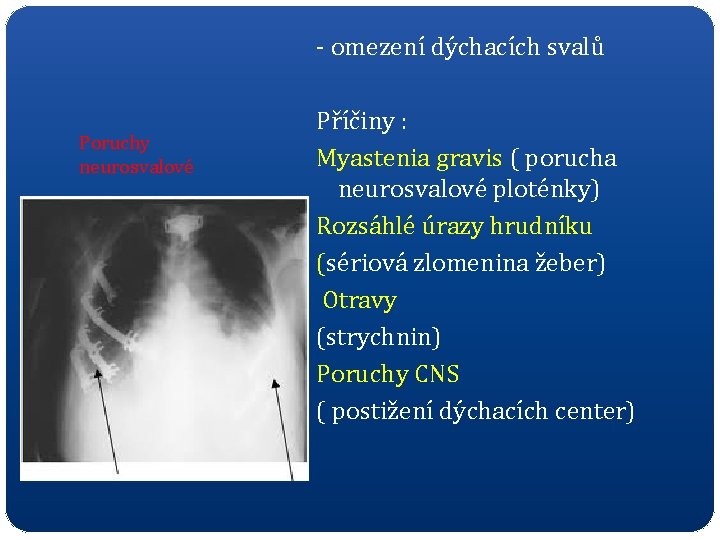 - omezení dýchacích svalů Poruchy neurosvalové Příčiny : Myastenia gravis ( porucha neurosvalové ploténky)