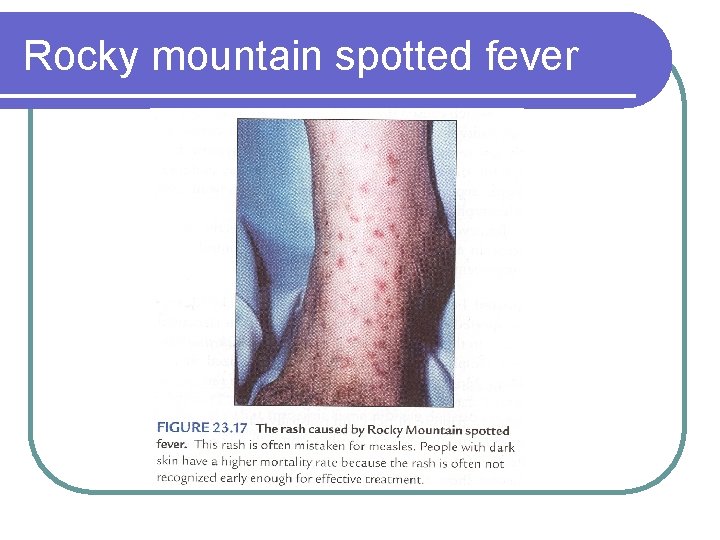 Rocky mountain spotted fever 