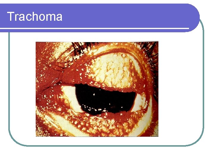 Trachoma 