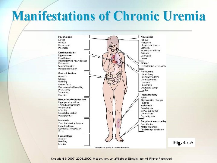 Manifestations of Chronic Uremia Fig. 47 -5 Copyright © 2007, 2004, 2000, Mosby, Inc. Manifestations of Chronic Uremia Fig. 47 -5 Copyright © 2007, 2004, 2000, Mosby, Inc.