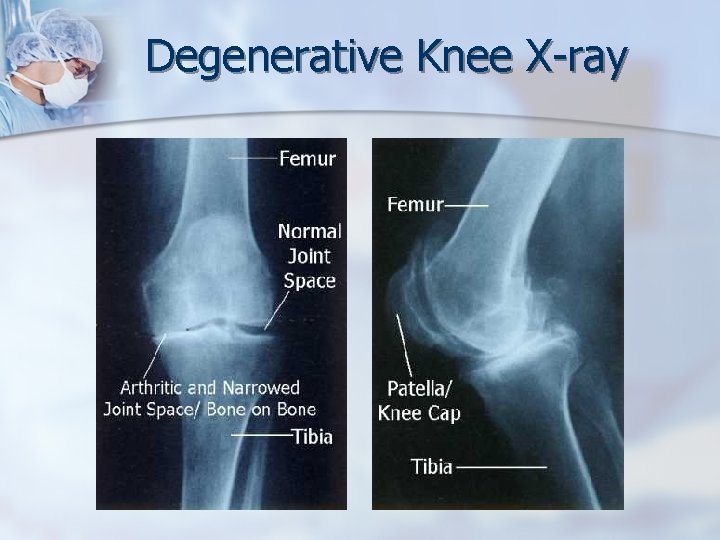 Degenerative Knee X-ray 