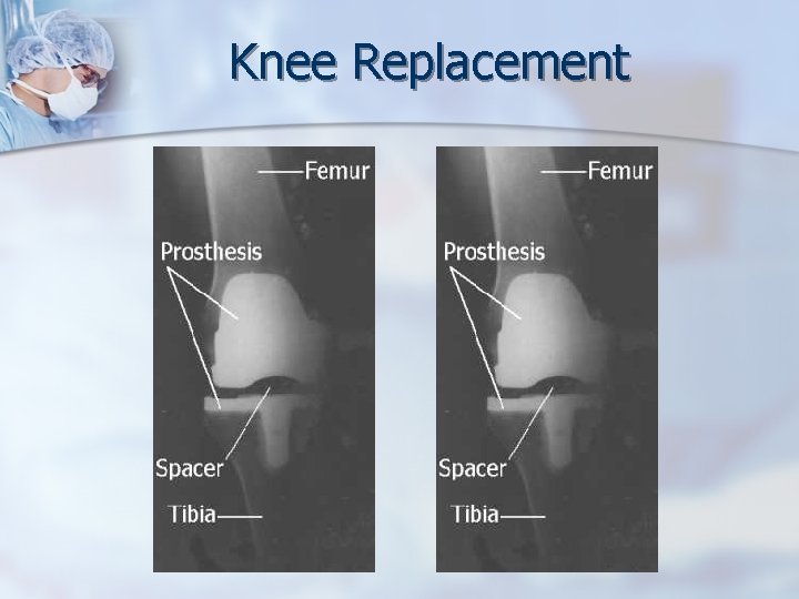 Knee Replacement 