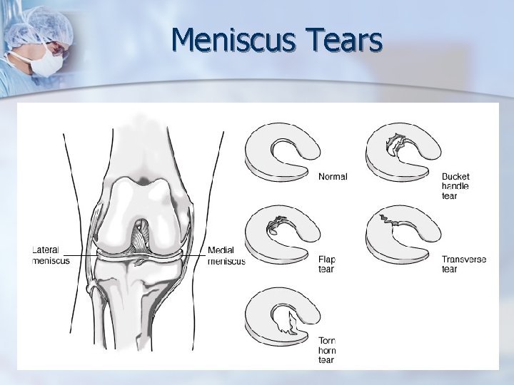 Meniscus Tears 