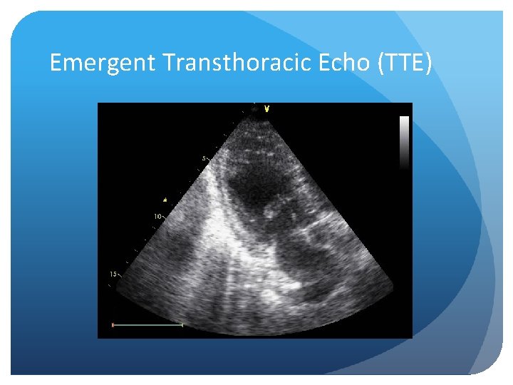 Emergent Transthoracic Echo (TTE) 
