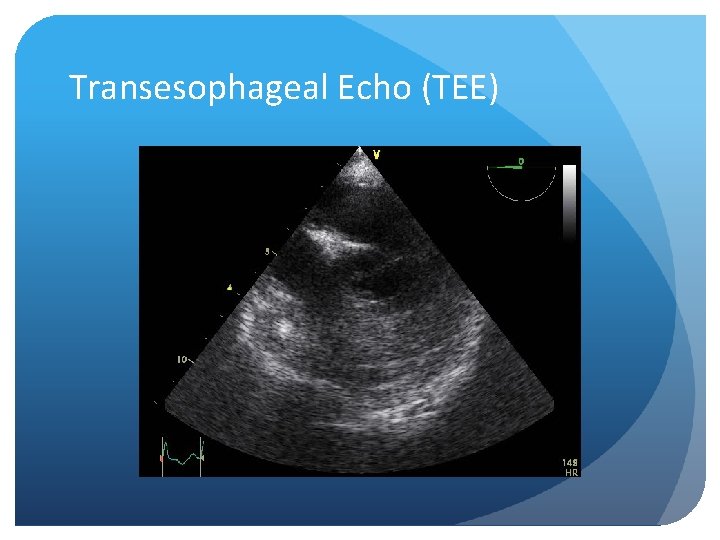 Transesophageal Echo (TEE) 