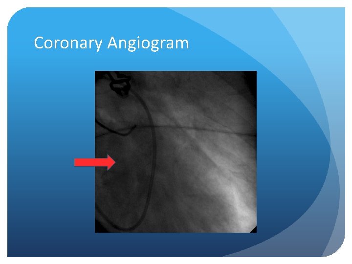 Coronary Angiogram 