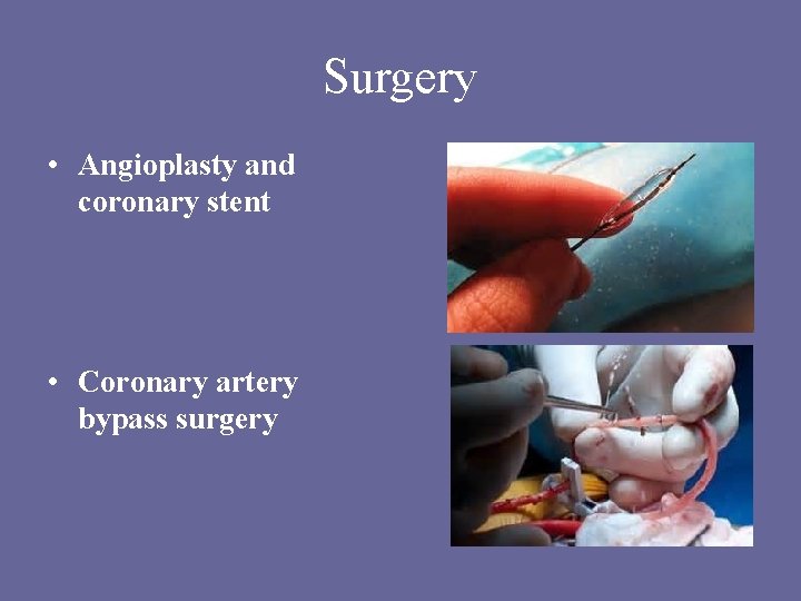 Surgery • Angioplasty and coronary stent • Coronary artery bypass surgery Surgery • Angioplasty and coronary stent • Coronary artery bypass surgery