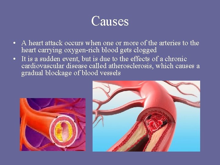 Causes • A heart attack occurs when one or more of the arteries to Causes • A heart attack occurs when one or more of the arteries to