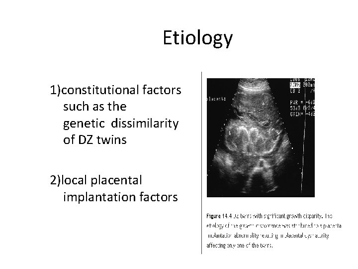 Etiology 1)constitutional factors such as the genetic dissimilarity of DZ twins 2)local placental implantation
