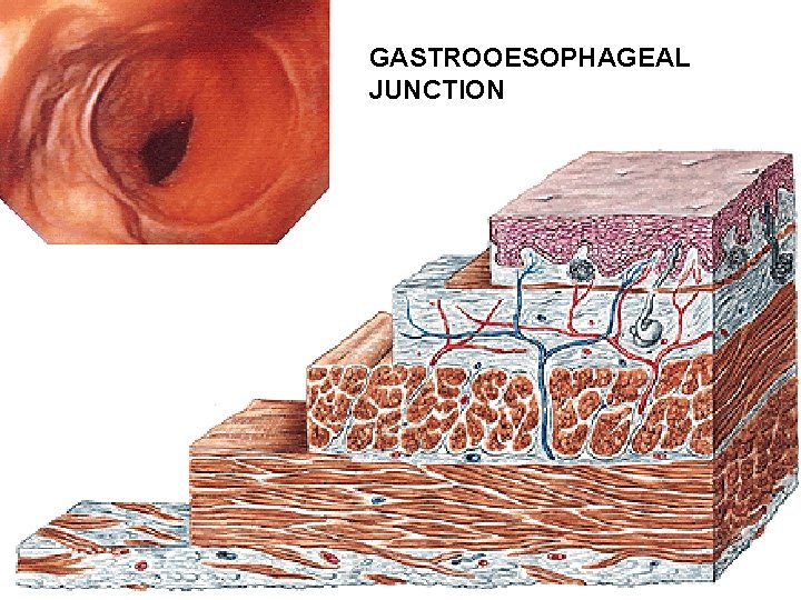 GASTROOESOPHAGEAL JUNCTION 