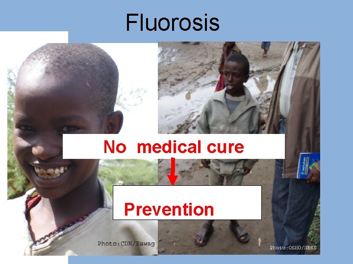 Fluorosis No medical cure Prevention 
