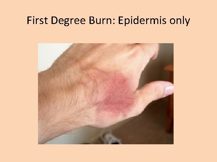 First Degree Burn: Epidermis only 