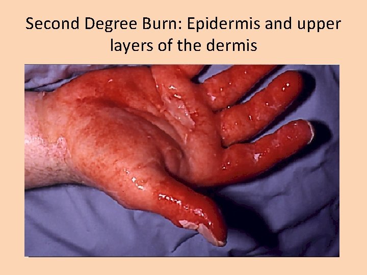 Second Degree Burn: Epidermis and upper layers of the dermis 