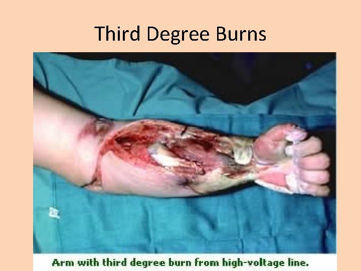 Third Degree Burns 