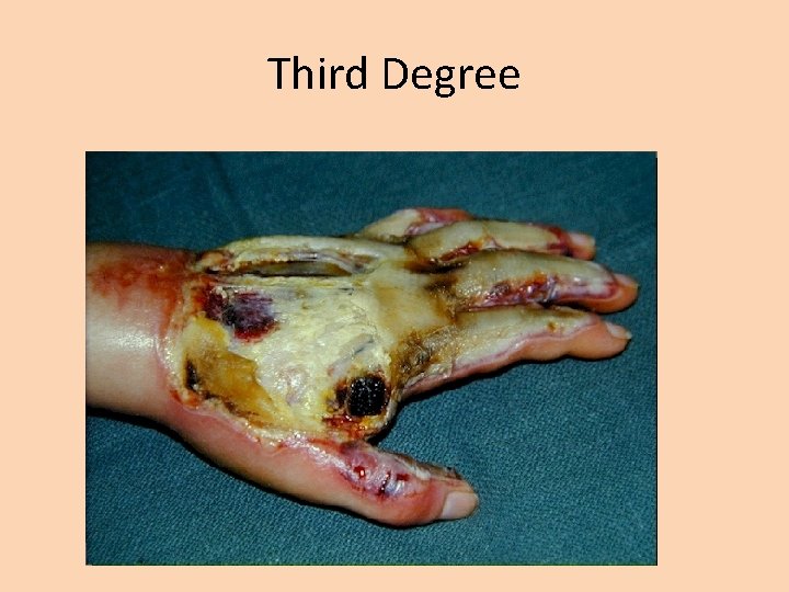 Third Degree 