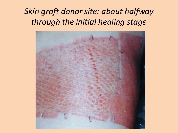 Skin graft donor site: about halfway through the initial healing stage 
