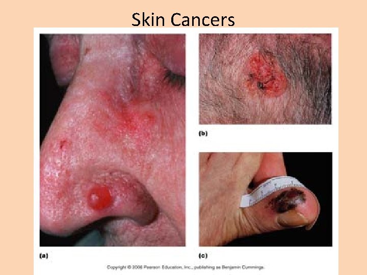 Skin Cancers 