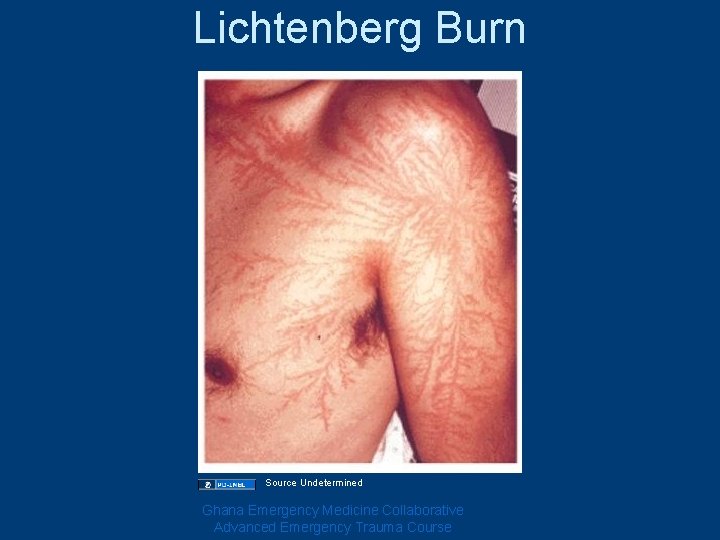 Lichtenberg Burn Source Undetermined Ghana Emergency Medicine Collaborative Advanced Emergency Trauma Course Lichtenberg Burn Source Undetermined Ghana Emergency Medicine Collaborative Advanced Emergency Trauma Course