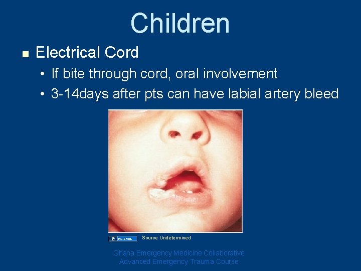 Children n Electrical Cord • If bite through cord, oral involvement • 3 -14 Children n Electrical Cord • If bite through cord, oral involvement • 3 -14