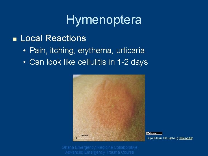 Hymenoptera n Local Reactions • Pain, itching, erythema, urticaria • Can look like cellulitis Hymenoptera n Local Reactions • Pain, itching, erythema, urticaria • Can look like cellulitis