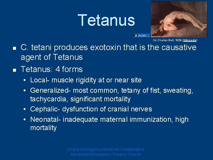 Tetanus Sir Charles Bell, 1809 (Wikipedia) n n C. tetani produces exotoxin that is Tetanus Sir Charles Bell, 1809 (Wikipedia) n n C. tetani produces exotoxin that is