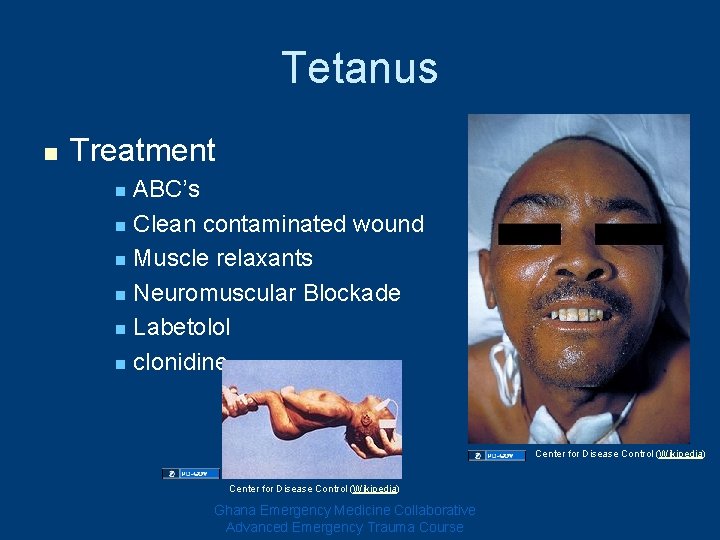 Tetanus n Treatment ABC’s n Clean contaminated wound n Muscle relaxants n Neuromuscular Blockade Tetanus n Treatment ABC’s n Clean contaminated wound n Muscle relaxants n Neuromuscular Blockade