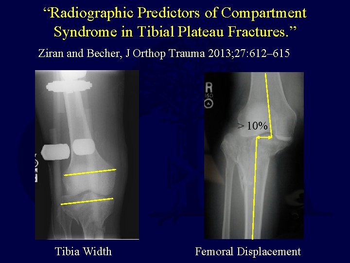 “Radiographic Predictors of Compartment Syndrome in Tibial Plateau Fractures. ” Ziran and Becher, J