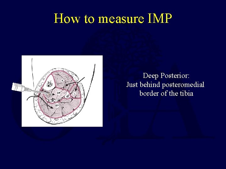 How to measure IMP Deep Posterior: Just behind posteromedial border of the tibia 