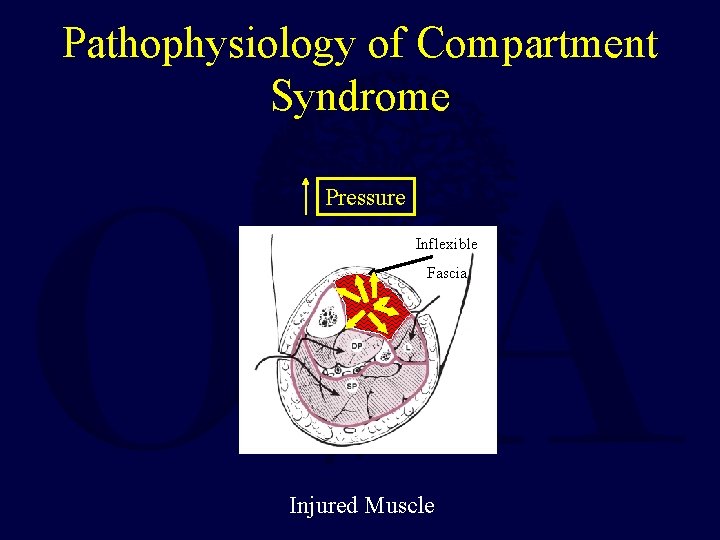 Pathophysiology of Compartment Syndrome Pressure Inflexible Fascia Injured Muscle 