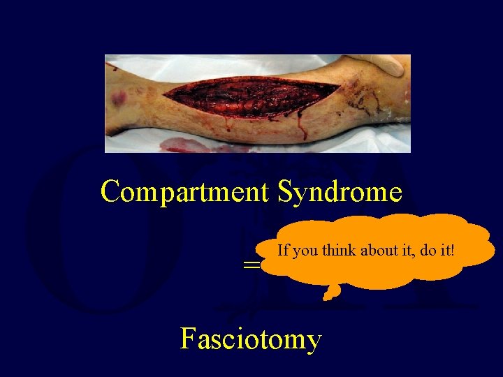 Compartment Syndrome = If you think about it, do it! Fasciotomy 