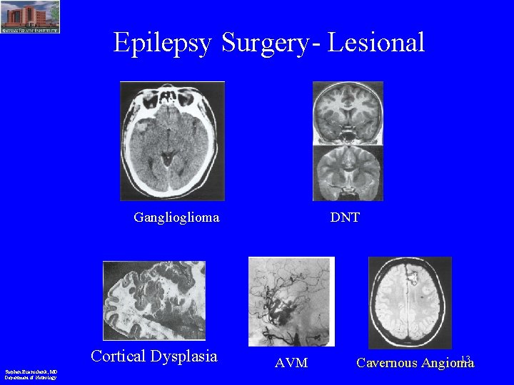 Epilepsy Surgery- Lesional Ganglioma Cortical Dysplasia Stephan Eisenschenk, MD Department of Neurology DNT AVM