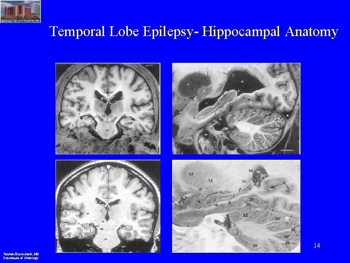 Temporal Lobe Epilepsy- Hippocampal Anatomy 14 Stephan Eisenschenk, MD Department of Neurology 
