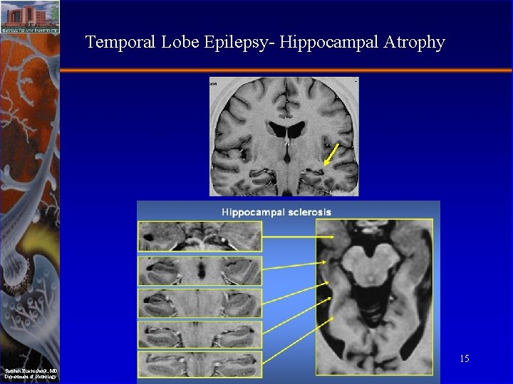 Temporal Lobe Epilepsy- Hippocampal Atrophy 15 Stephan Eisenschenk, MD Department of Neurology 