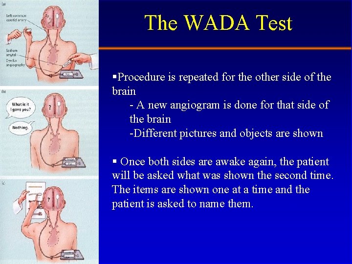The WADA Test §Procedure is repeated for the other side of the brain -