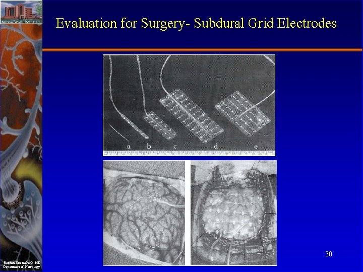Evaluation for Surgery- Subdural Grid Electrodes 30 Stephan Eisenschenk, MD Department of Neurology 