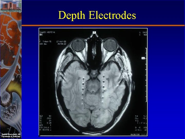 Depth Electrodes Stephan Eisenschenk, MD Department of Neurology 