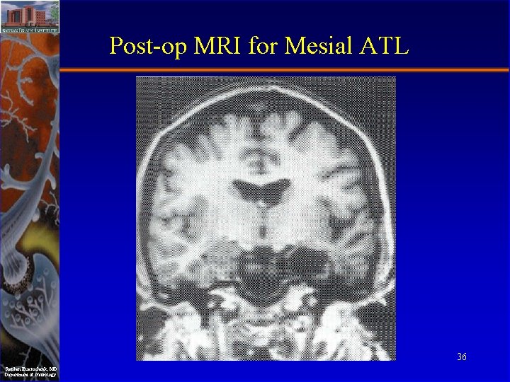 Post-op MRI for Mesial ATL 36 Stephan Eisenschenk, MD Department of Neurology 