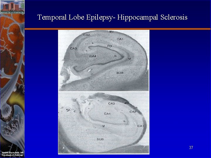 Temporal Lobe Epilepsy- Hippocampal Sclerosis 37 Stephan Eisenschenk, MD Department of Neurology 