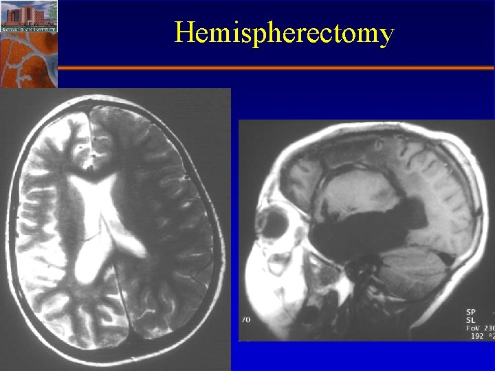 Hemispherectomy Stephan Eisenschenk, MD Department of Neurology 