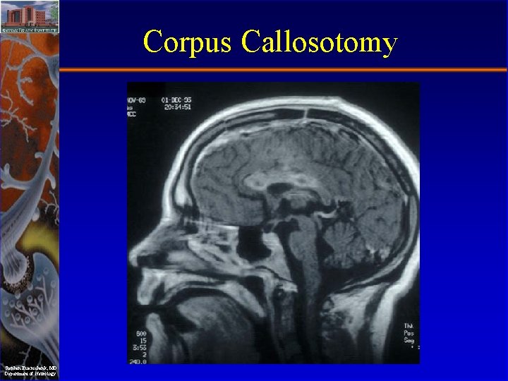 Corpus Callosotomy Stephan Eisenschenk, MD Department of Neurology 