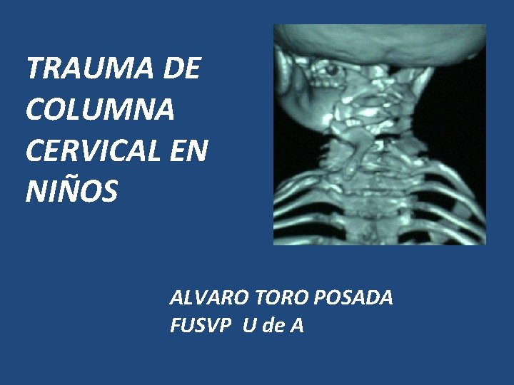 TRAUMA DE COLUMNA CERVICAL EN NIÑOS ALVARO TORO POSADA FUSVP U de A 